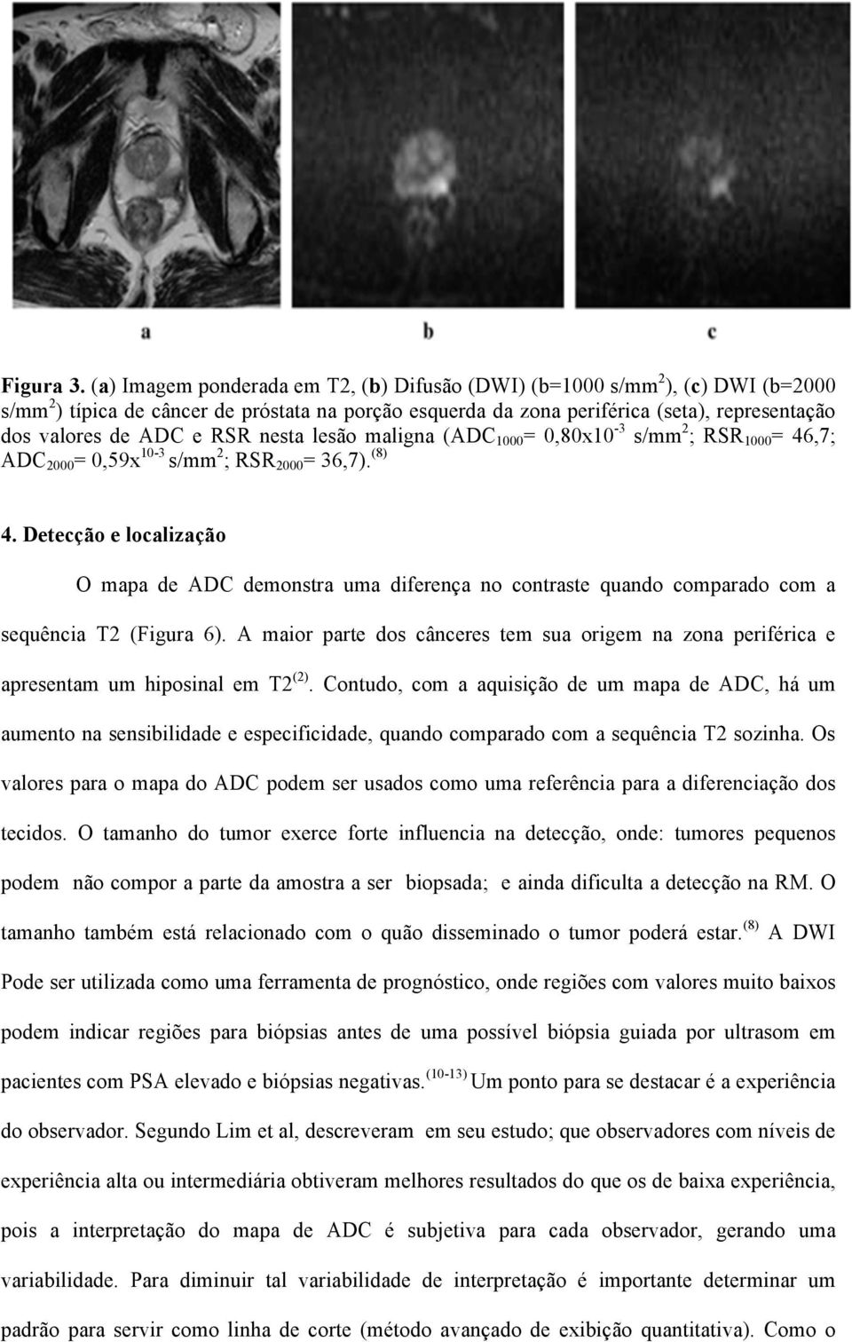 RSR nesta lesão maligna (ADC 1000 = 0,80x10-3 s/mm 2 ; RSR 1000 = 46,7; ADC 2000 = 0,59x 10-3 s/mm 2 ; RSR 2000 = 36,7). (8) 4.