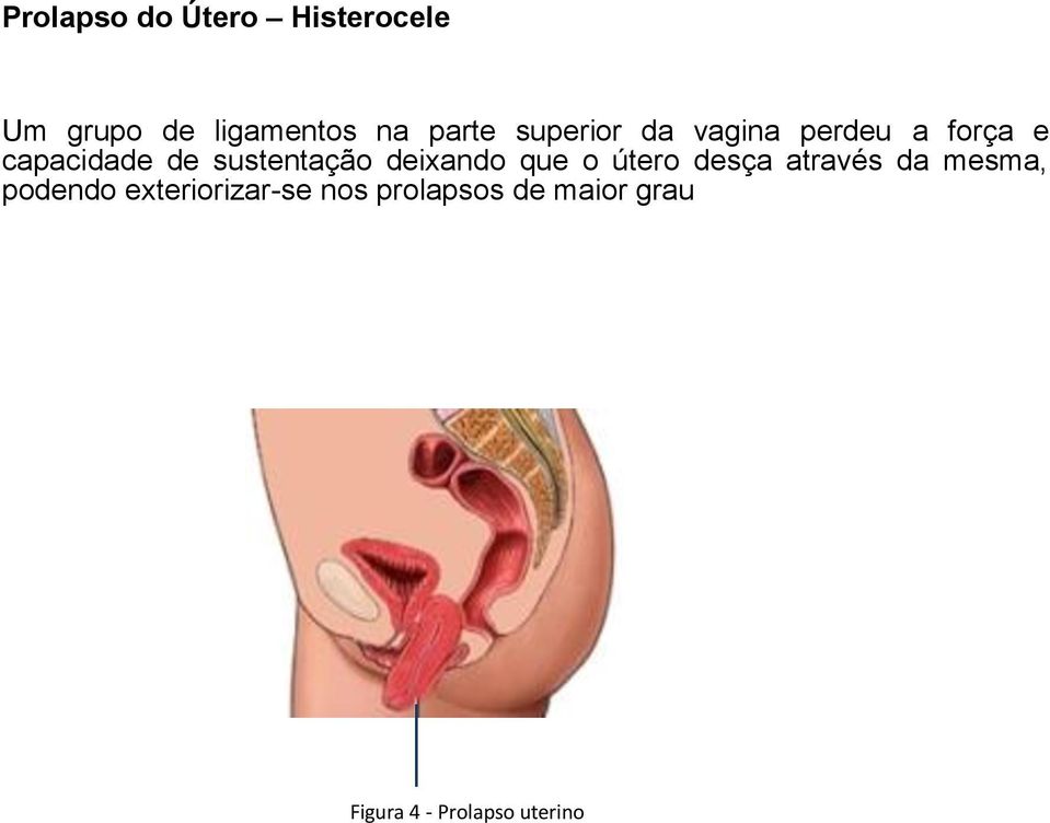 deixando que o útero desça através da mesma, podendo