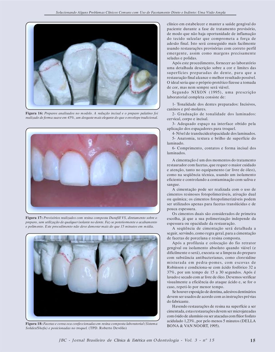 Este procedimento não deve demorar mais do que 15 minutos em média. Figura 18: Facetas e coroa oca confeccionadas em resina composta laboratorial (Sistema Solidex/Shofu) e posicionadas no troquel.