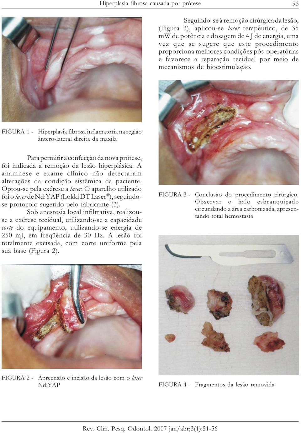 FIGURA 1 - Hiperplasia fibrosa inflamatória na região ântero-lateral direita da maxila Para permitir a confecção da nova prótese, foi indicada a remoção da lesão hiperplásica.