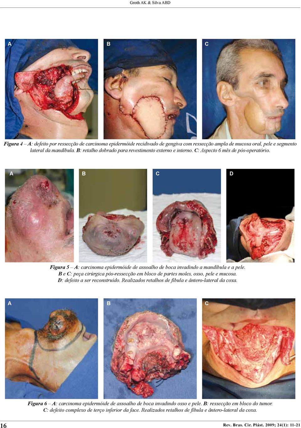 B e C: peça cirúrgica pós-ressecção em bloco de partes moles, osso, pele e mucosa. D: defeito a ser reconstruído. Realizados retalhos de fíbula e ântero-lateral da coxa.