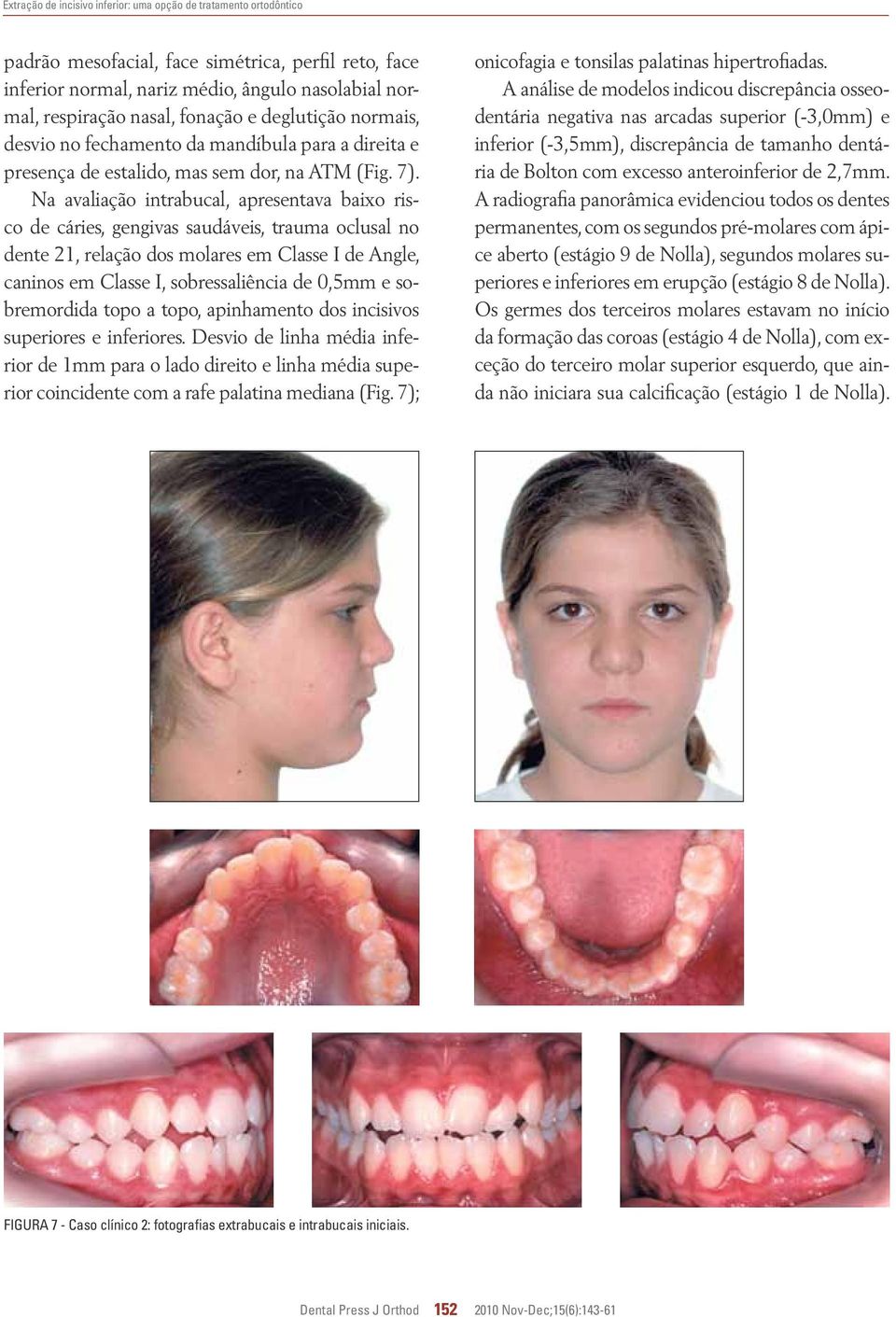 Na avaliação intrabucal, apresentava baixo risco de cáries, gengivas saudáveis, trauma oclusal no dente 21, relação dos molares em Classe I de Angle, caninos em Classe I, sobressaliência de 0,5mm e