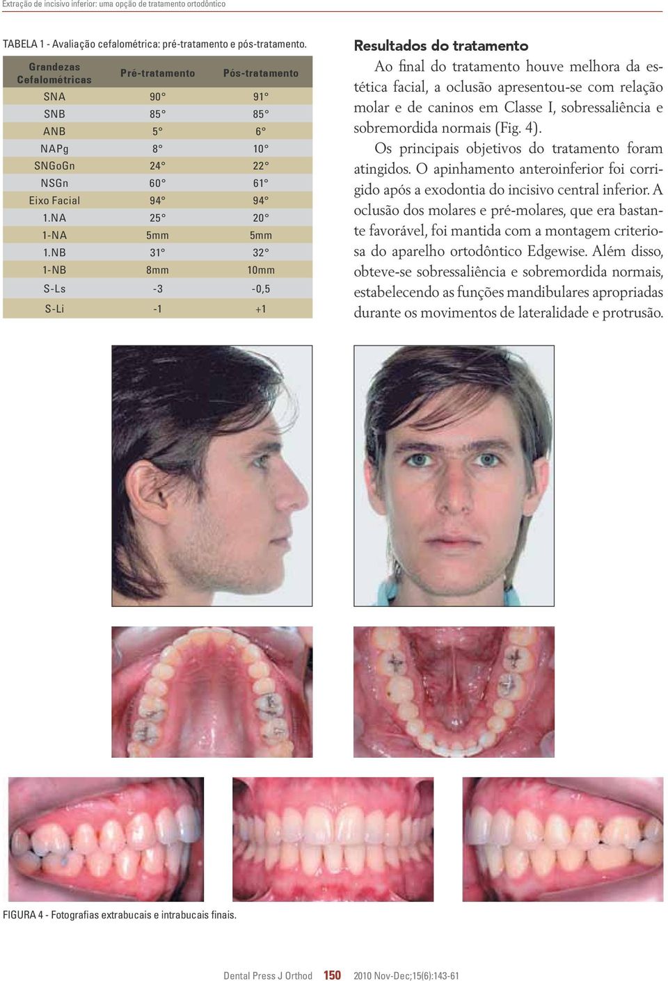 NB 31 32 1-NB 8mm 10mm S-Ls -3-0,5 S-Li -1 +1 Resultados do tratamento Ao final do tratamento houve melhora da estética facial, a oclusão apresentou-se com relação molar e de caninos em Classe I,