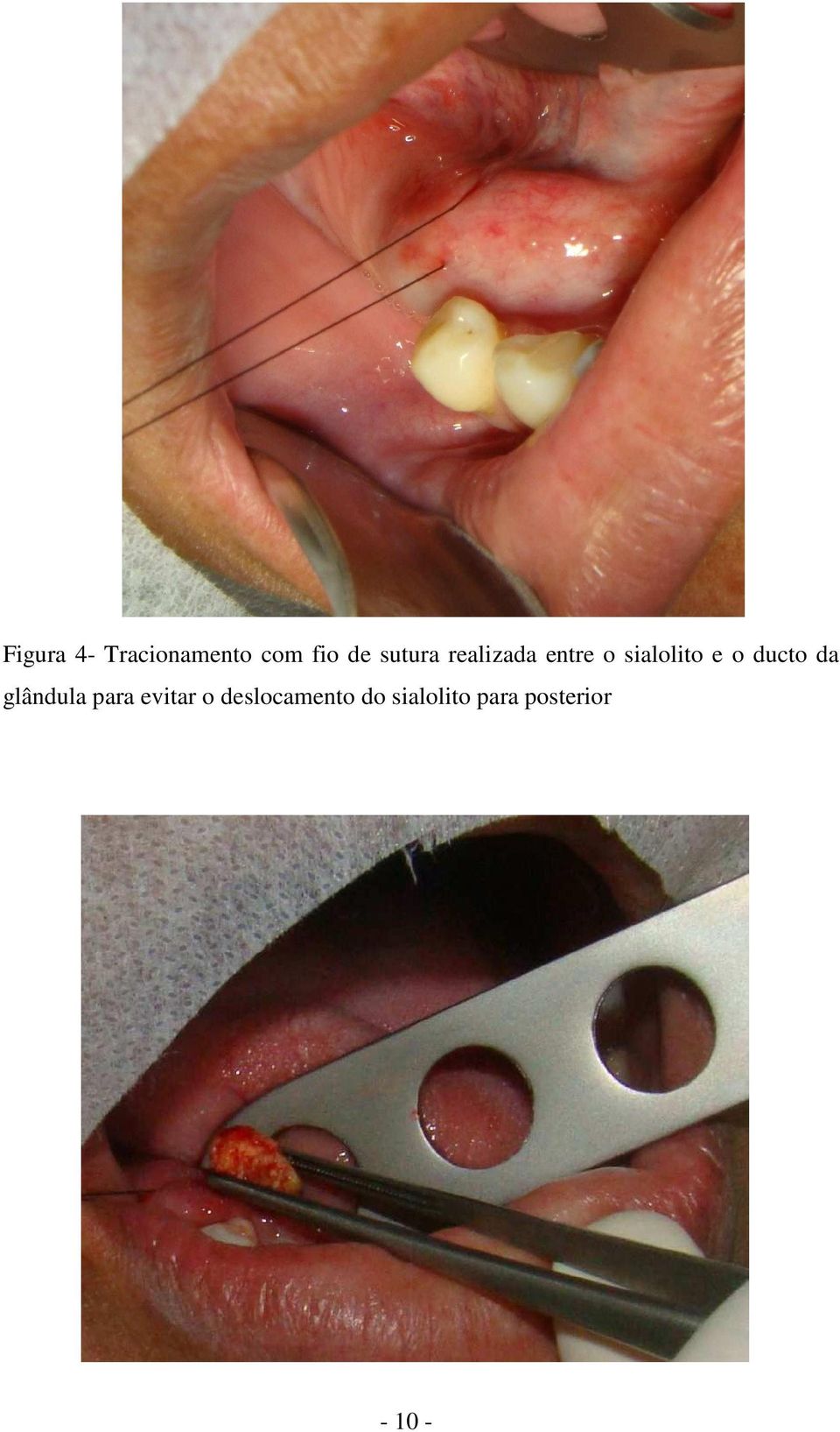 ducto da glândula para evitar o