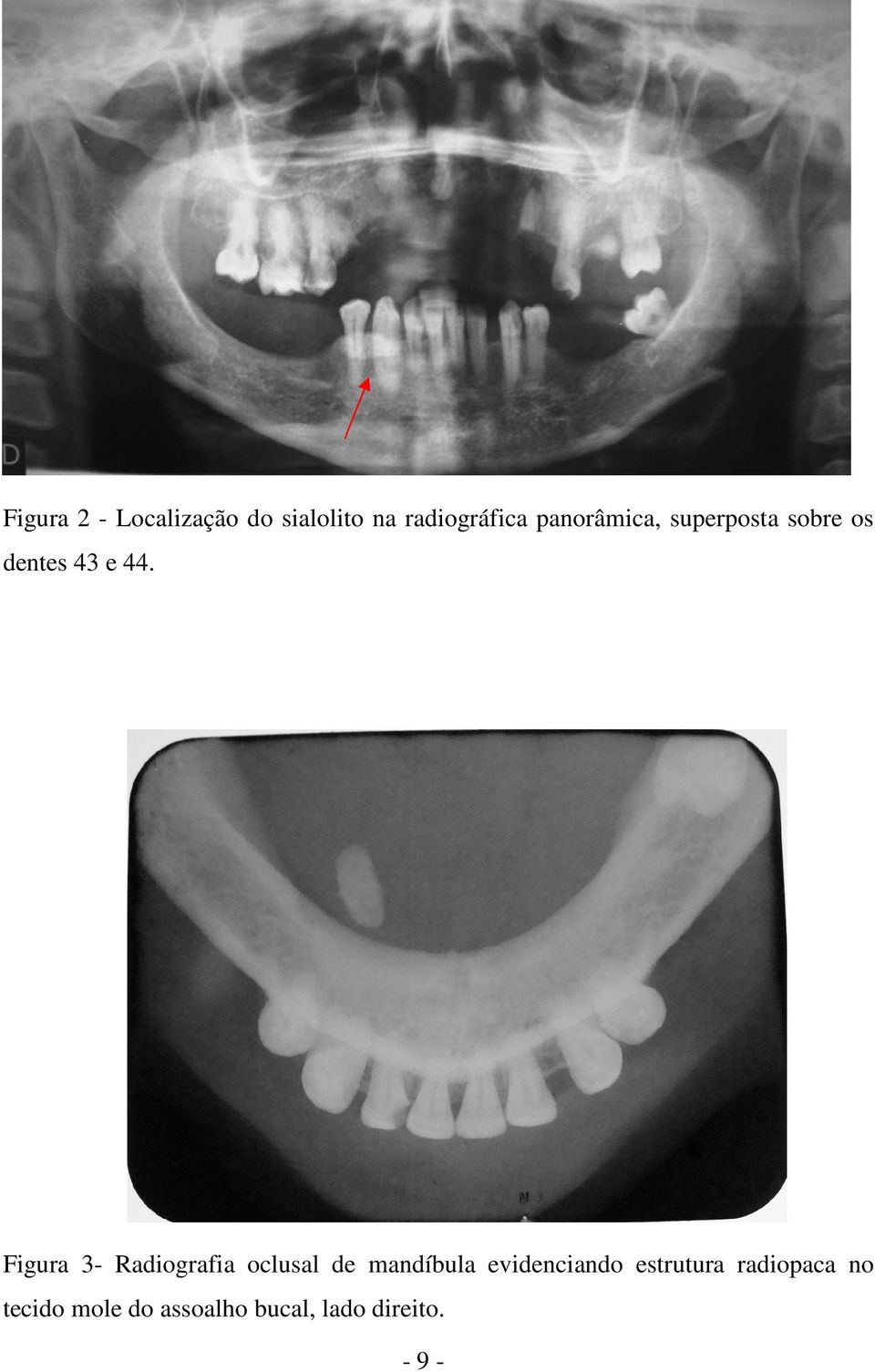 Figura 3- Radiografia oclusal de mandíbula evidenciando