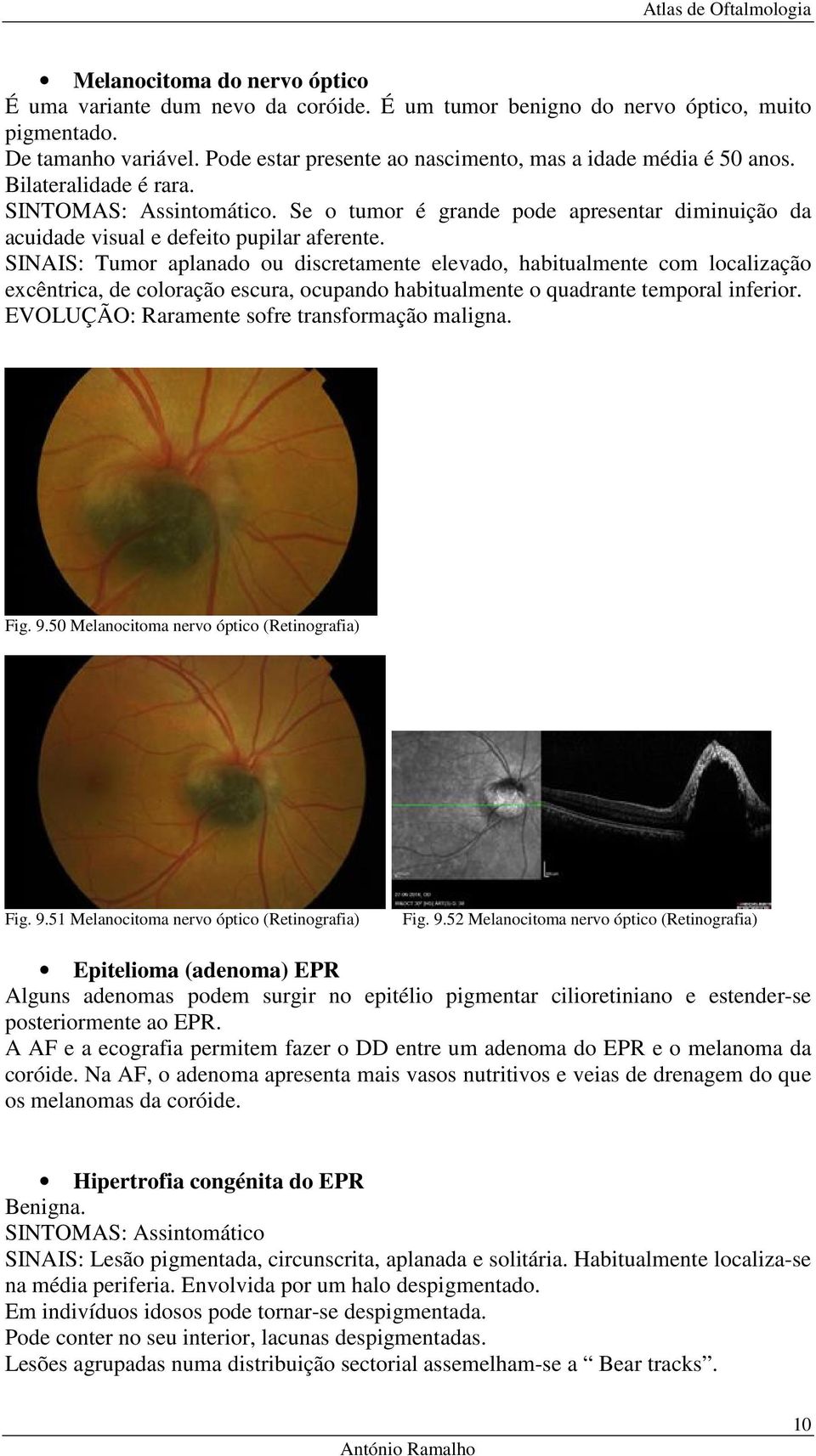 Se o tumor é grande pode apresentar diminuição da acuidade visual e defeito pupilar aferente.