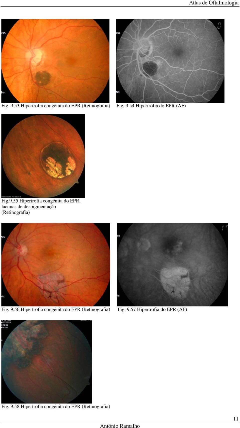 Fig. 9.56 Hipertrofia congénita do EPR (Retinografia) Fig. 9.57 Hipertrofia do EPR (AF) Fig.