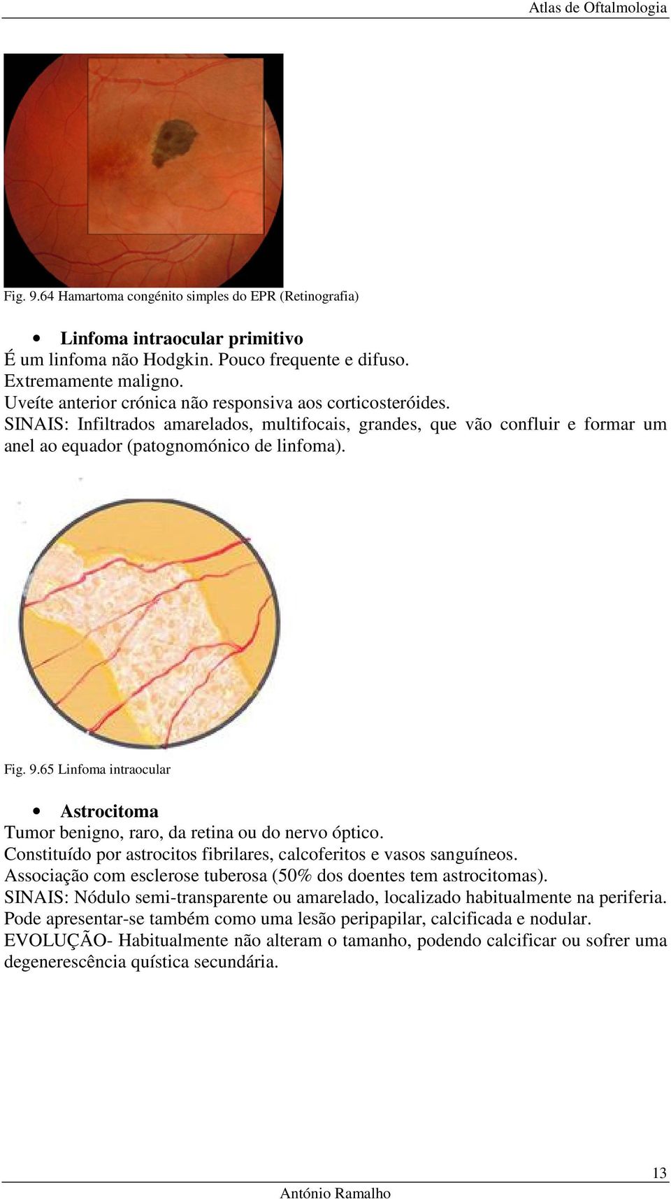 65 Linfoma intraocular Astrocitoma Tumor benigno, raro, da retina ou do nervo óptico. Constituído por astrocitos fibrilares, calcoferitos e vasos sanguíneos.