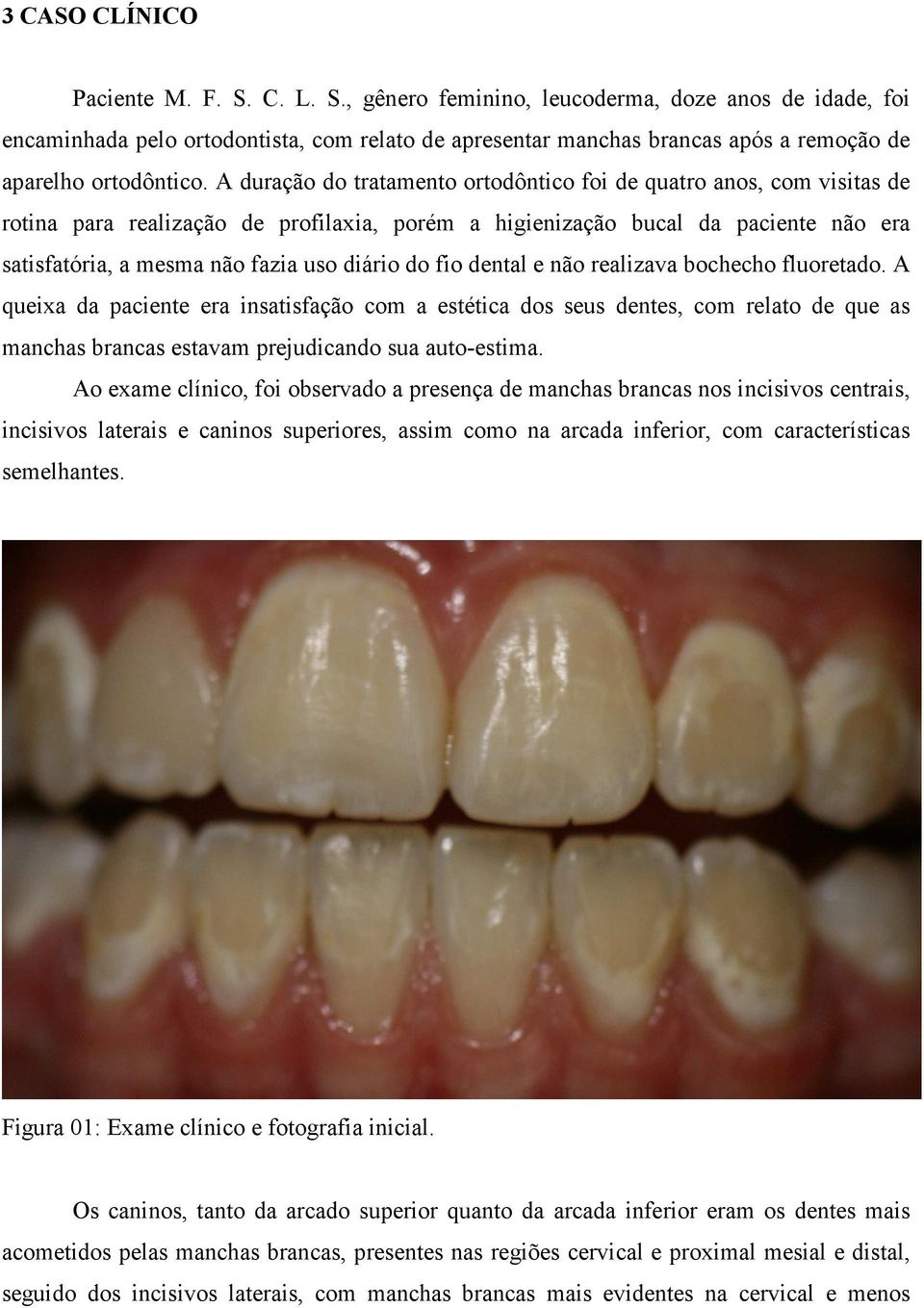 do fio dental e não realizava bochecho fluoretado. A queixa da paciente era insatisfação com a estética dos seus dentes, com relato de que as manchas brancas estavam prejudicando sua auto-estima.