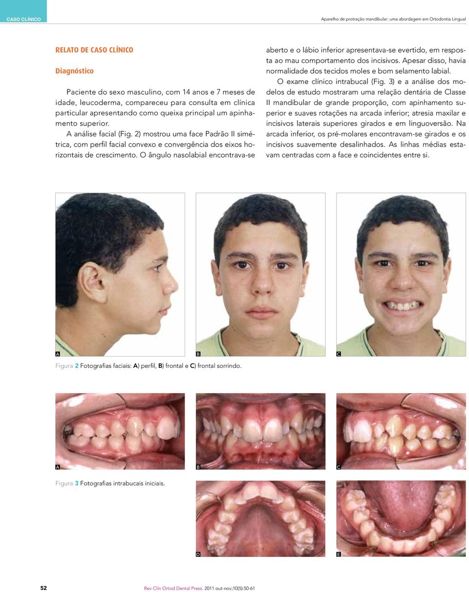 2) mostrou uma face Padrão II simétrica, com perfil facial convexo e convergência dos eixos horizontais de crescimento.