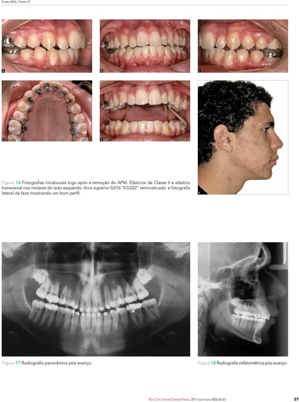 rco superior 0,016 X 0,022 termoativado e fotografia lateral da face mostrando um bom perfil.