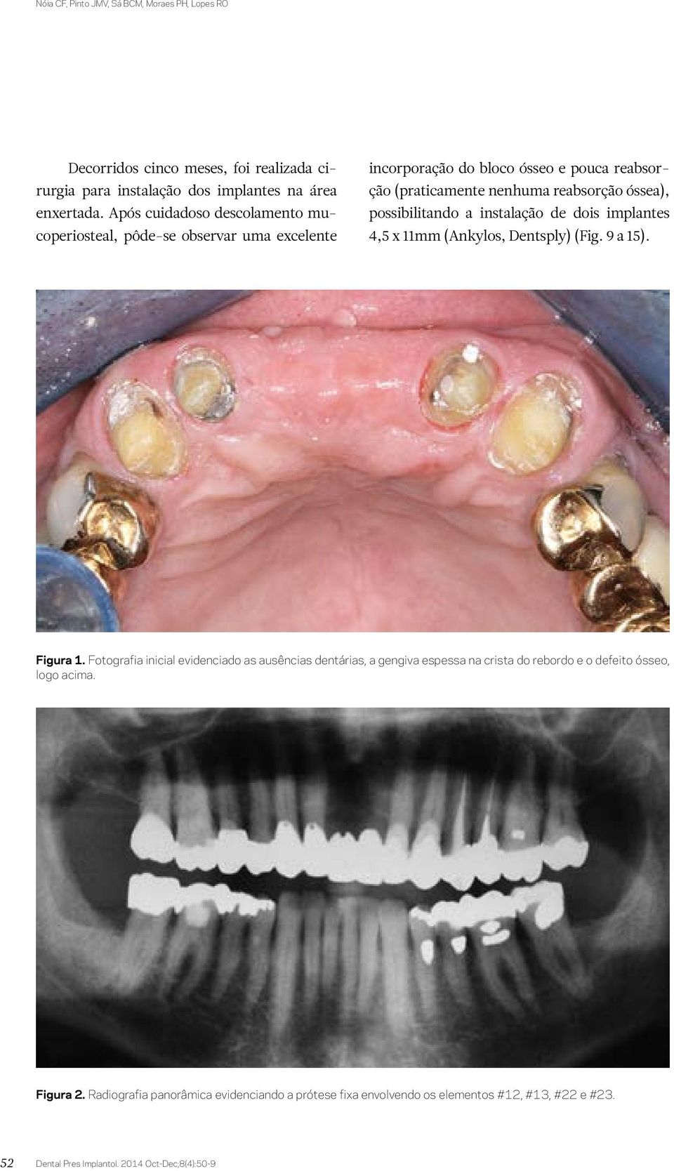 possibilitando a instalação de dois implantes 4,5 x 11mm (Ankylos, Dentsply) (Fig. 9 a 15). Figura 1.