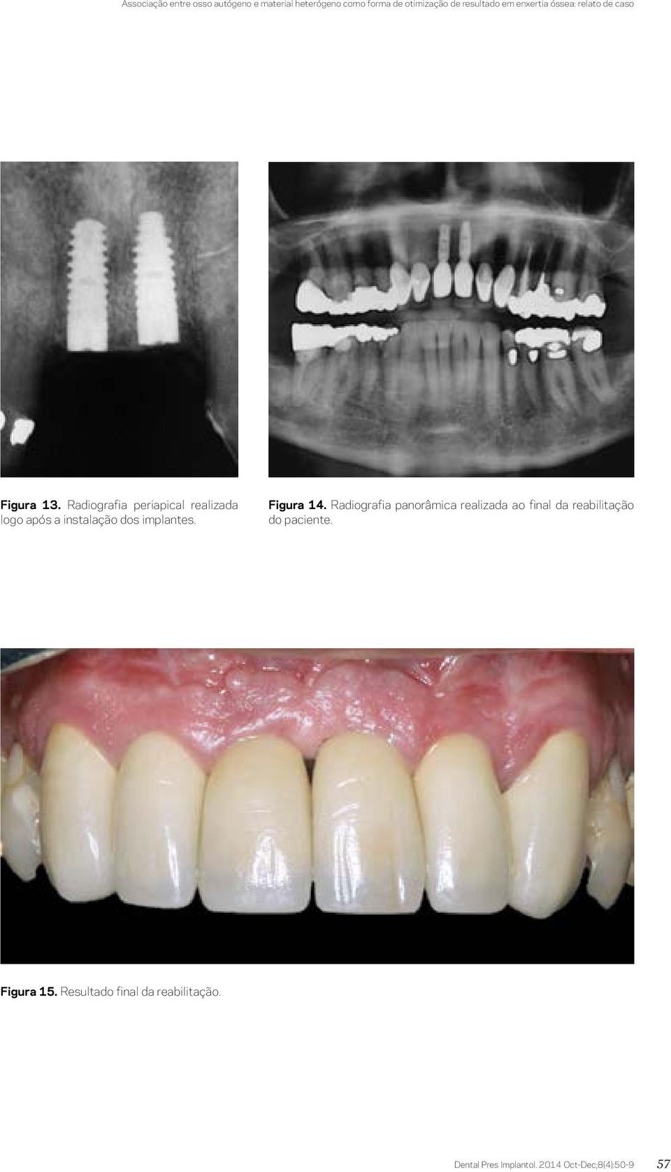 Radiografia periapical realizada logo após a instalação dos implantes. Figura 14.