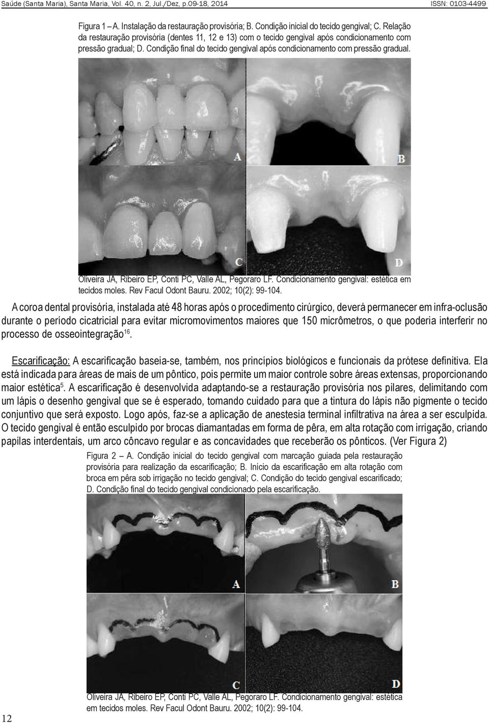 Oliveira JA, Ribeiro EP, Conti PC, Valle AL, Pegoraro LF. Condicionamento gengival: estética em tecidos moles. Rev Facul Odont Bauru. 2002; 10(2): 99-104.