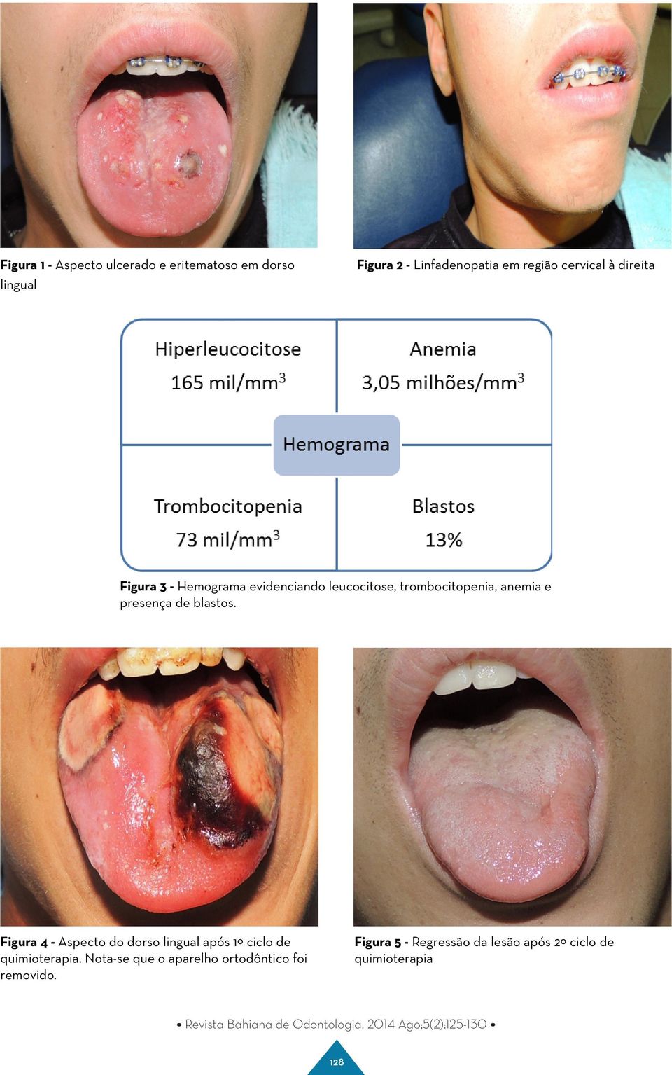 presença de blastos. Figura 4 - Aspecto do dorso lingual após 1º ciclo de quimioterapia.