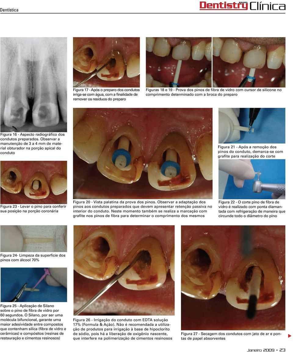 Observar a manutenção de 3 a 4 mm de material obturador na porção apical do conduto Figura 21 - Após a remoção dos pinos do conduto, demarca-se com grafite para realização do corte Figura 23 - Levar