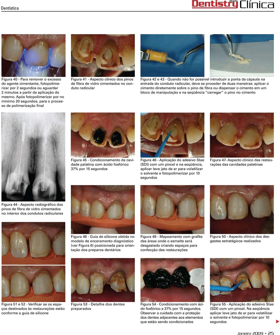 possível introduzir a ponta da cápsula na entrada do conduto radicular, deve se proceder de duas maneiras: aplicar o cimento diretamente sobre o pino de fibra ou dispensar o cimento em um bloco de