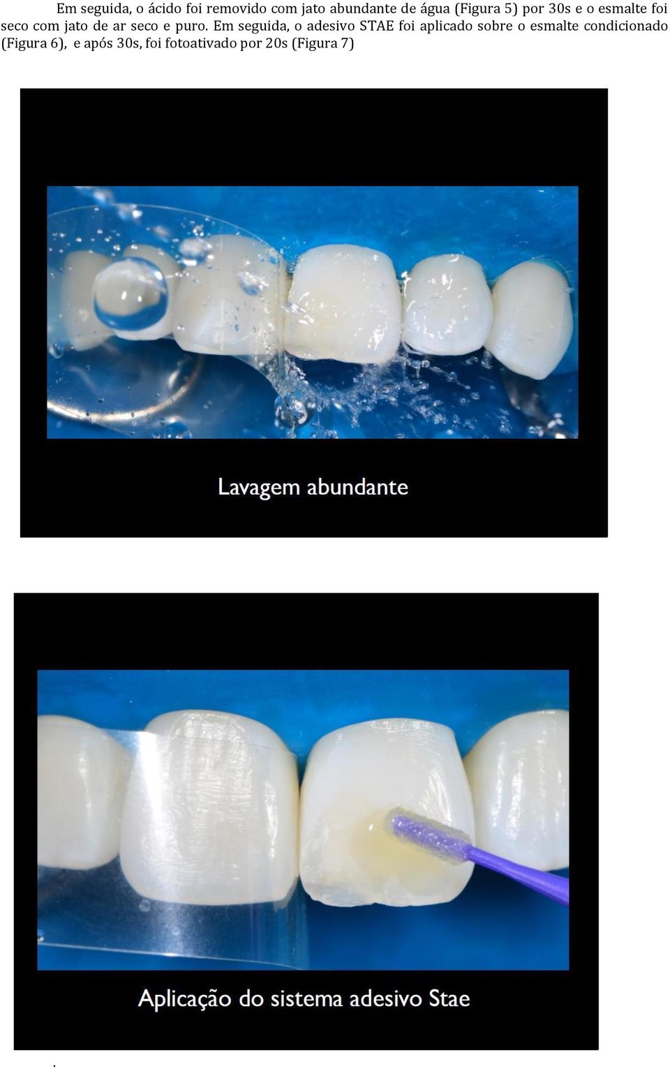 puro. Em seguida, o adesivo STAE foi aplicado sobre o esmalte
