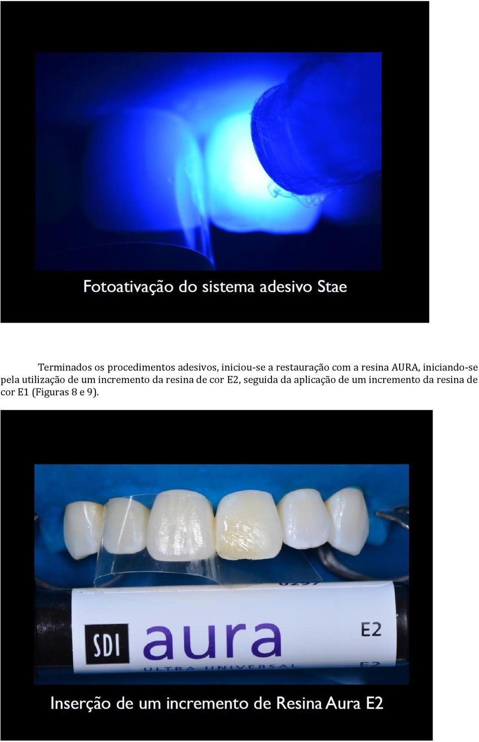 utilização de um incremento da resina de cor E2,