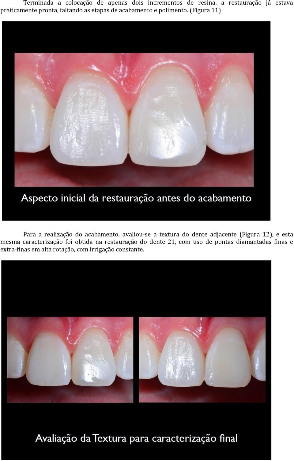(Figura 11) Para a realização do acabamento, avaliou-se a textura do dente adjacente (Figura 12), e