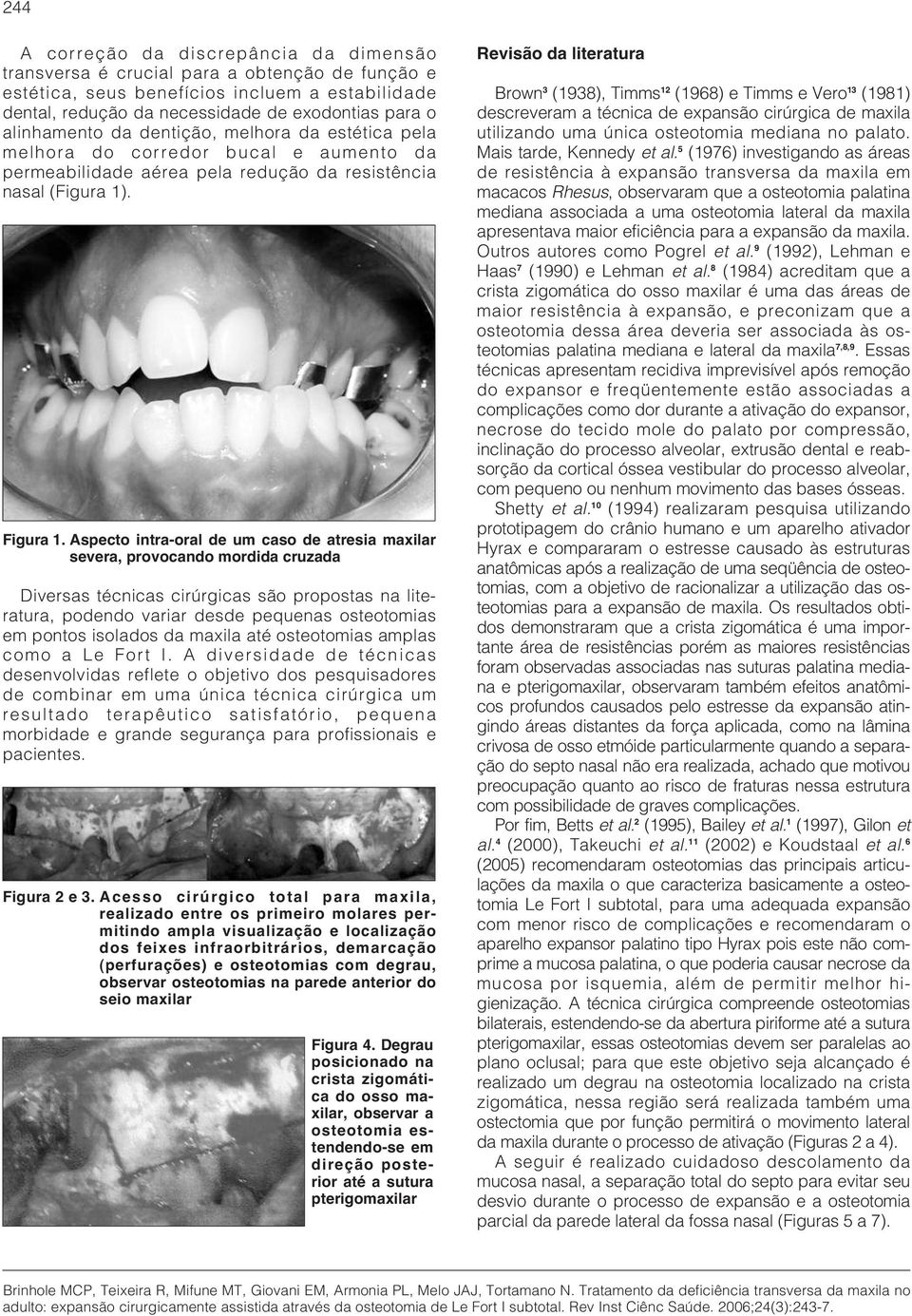 Aspecto intra-oral de um caso de atresia maxilar severa, provocando mordida cruzada Diversas técnicas cirúrgicas são propostas na literatura, podendo variar desde pequenas osteotomias em pontos