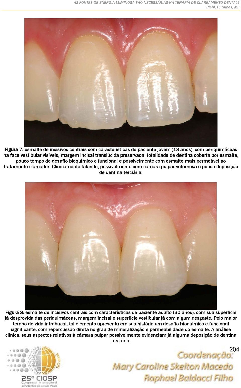 Clinicamente falando, possivelmente com câmara pulpar volumosa e pouca deposição de dentina terciária.