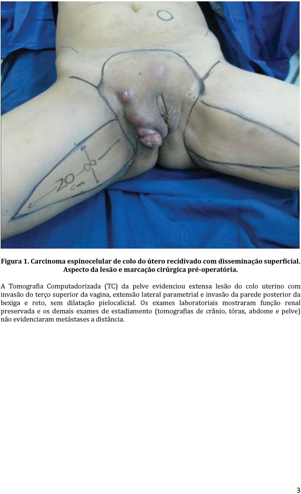 A Tomografia Computadorizada (TC) da pelve evidenciou extensa lesão do colo uterino com invasão do terço superior da vagina, extensão