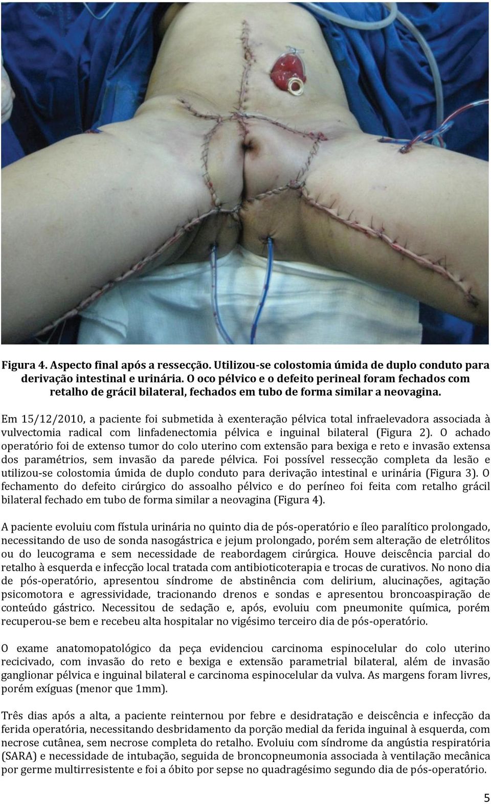 Em 15/12/2010, a paciente foi submetida à exenteração pélvica total infraelevadora associada à vulvectomia radical com linfadenectomia pélvica e inguinal bilateral (Figura 2).