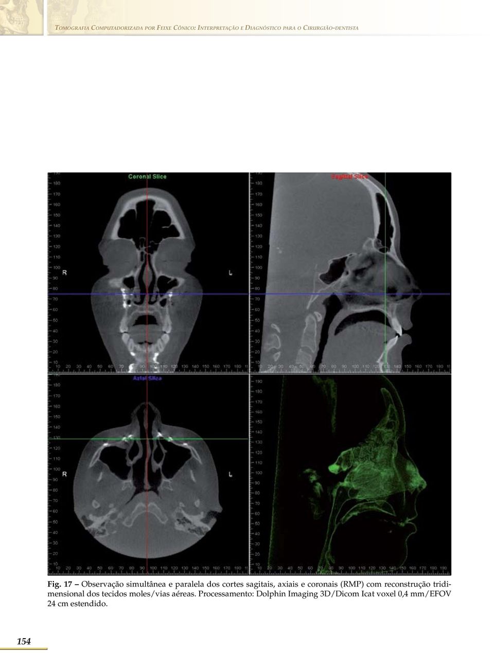 17 Observação simultânea e paralela dos cortes sagitais, axiais e coronais (RMP)