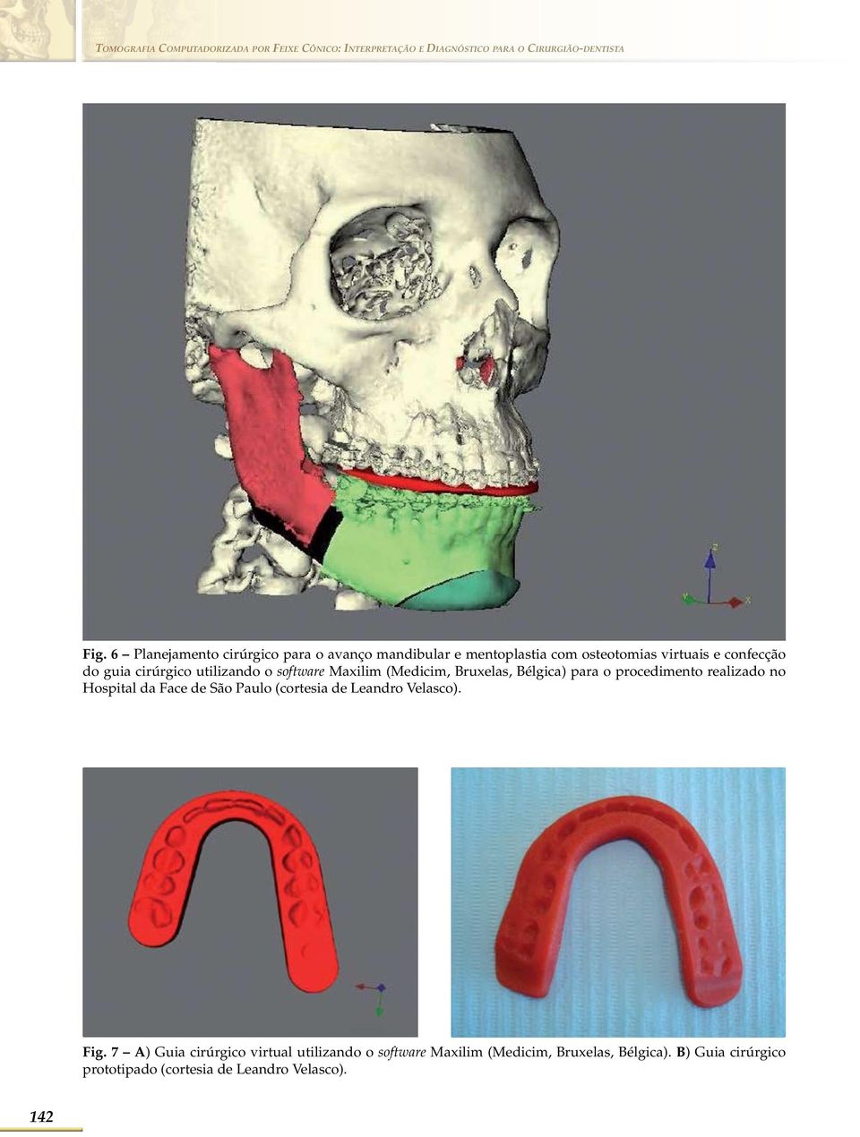 software Maxilim (Medicim, Bruxelas, Bélgica) para o procedimento realizado no Hospital da Face de São Paulo (cortesia de Leandro