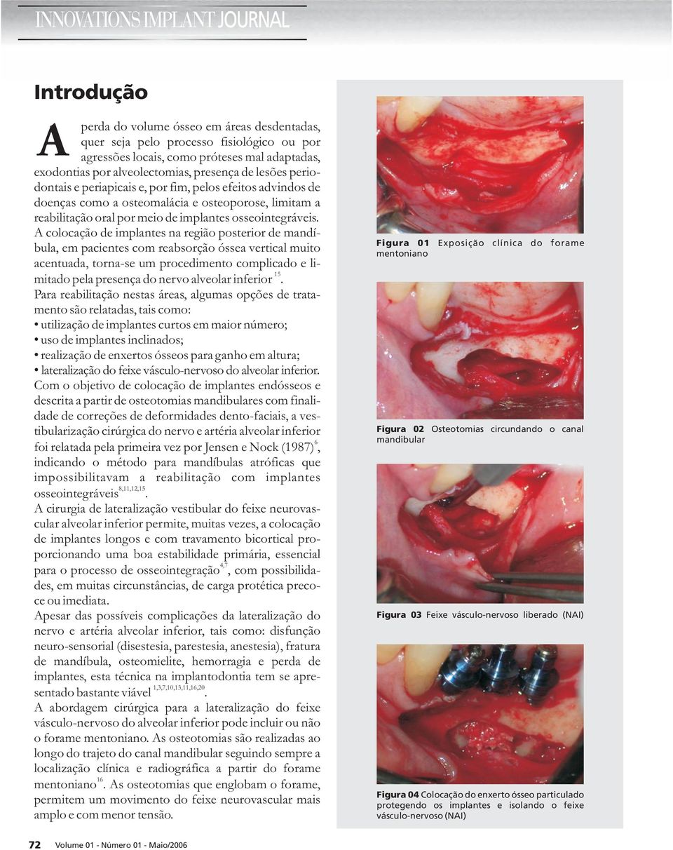 A colocação de implantes na região posterior de mandíbula, em pacientes com reabsorção óssea vertical muito acentuada, torna-se um procedimento complicado e limitado pela presença do nervo alveolar