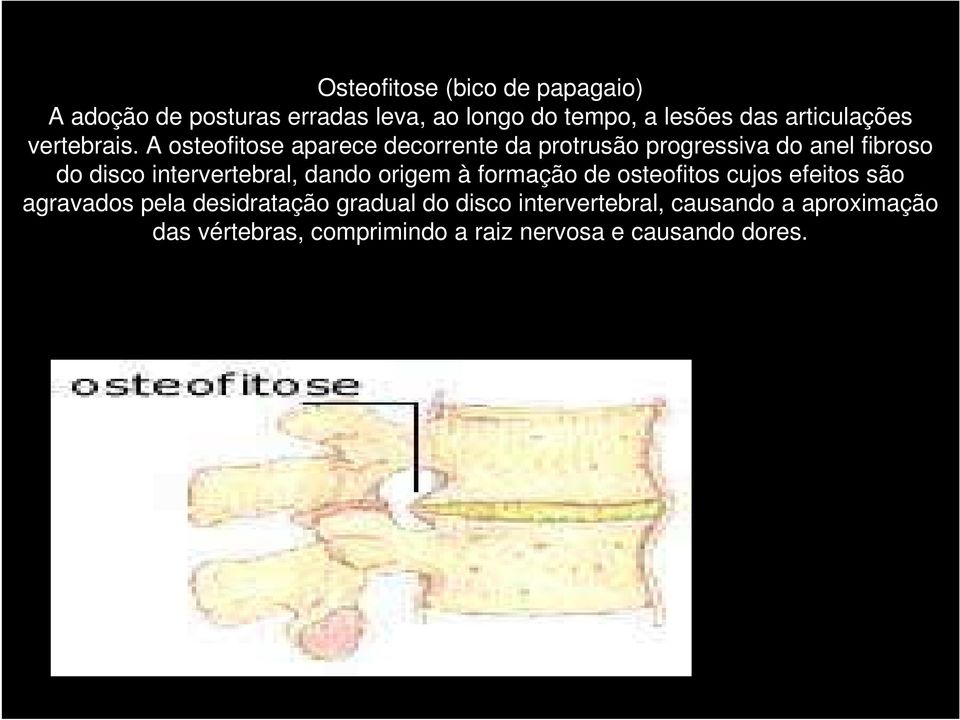 A osteofitose aparece decorrente da protrusão progressiva do anel fibroso do disco intervertebral, dando