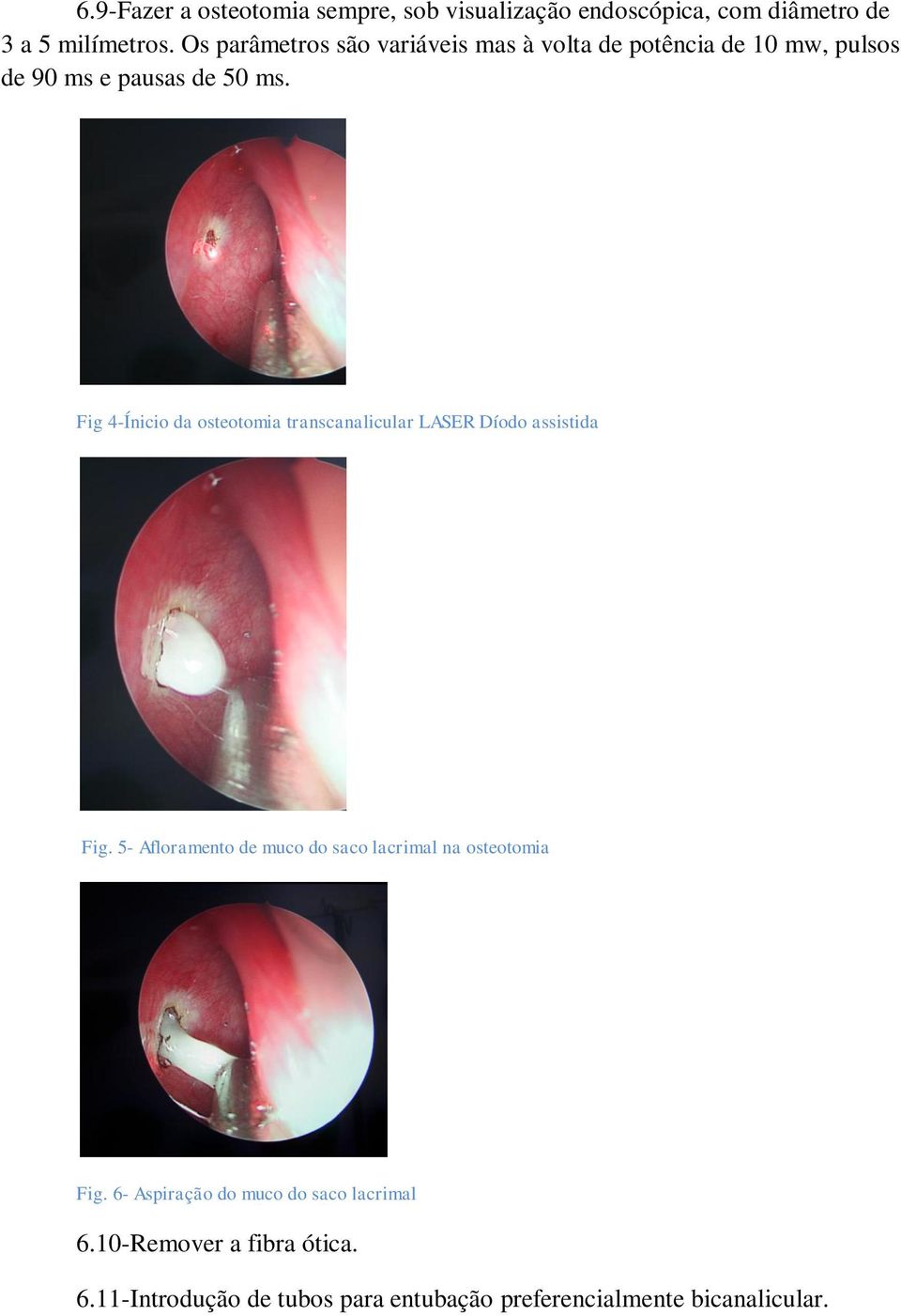 Fig 4-Ínicio da osteotomia transcanalicular LASER Díodo assistida Fig.