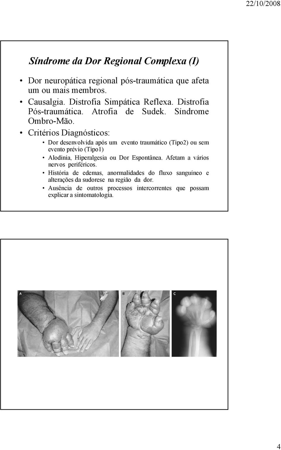 Critérios Diagnósticos: Dor desenvolvida após um evento traumático (Tipo2) ou sem evento prévio (Tipo1) Alodinia, Hiperalgesia ou Dor