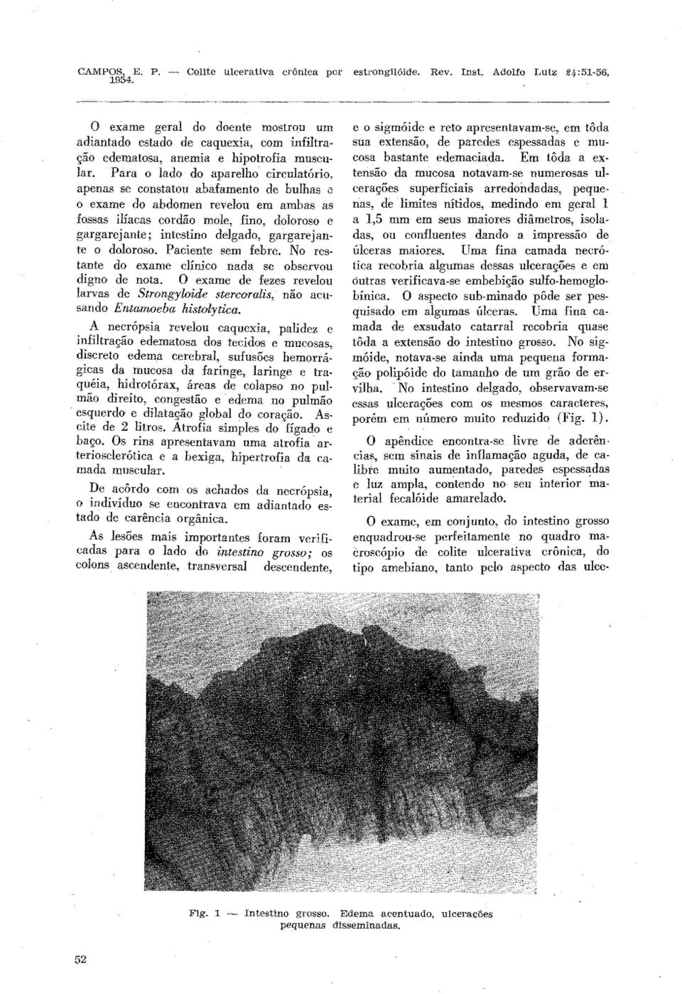 apenas se constatou abafamento de bulhas e o exame do abdomen revelou em ambas as fossas ilíacas cordão mole, fino, doloroso e gargarejante; intestino delgado, gargarejante o doloroso.