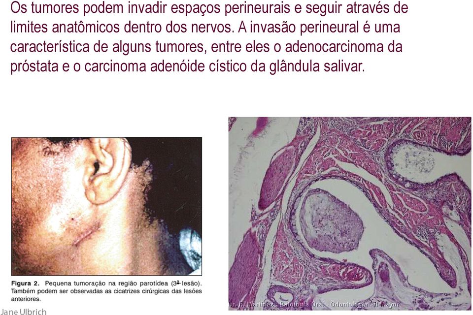 A invasão perineural é uma característica de alguns tumores,