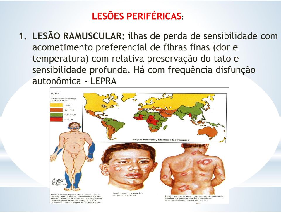 acometimento preferencial de fibras finas (dor e