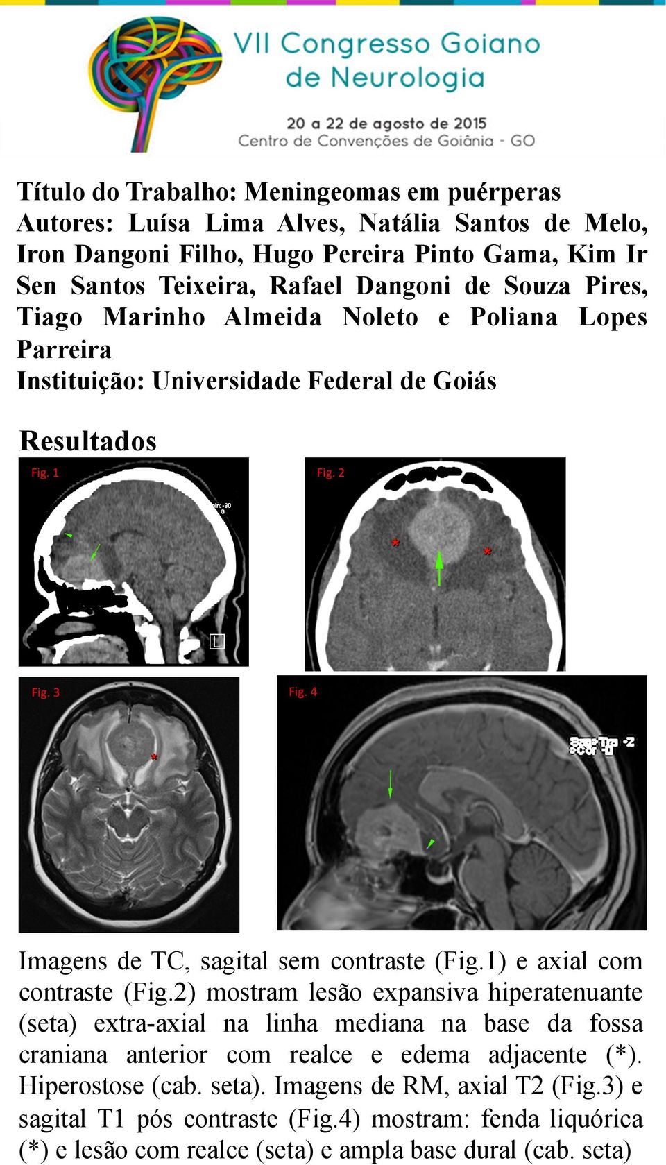 2) mostram lesão expansiva hiperatenuante (seta) extra-axial na linha mediana na base da fossa craniana