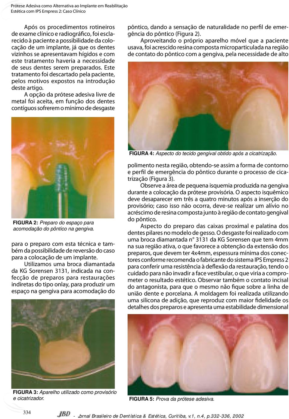 A opção da prótese adesiva livre de metal foi aceita, em função dos dentes contíguos sofrerem o mínimo de desgaste pôntico, dando a sensação de naturalidade no perfil de emergência do pôntico (Figura