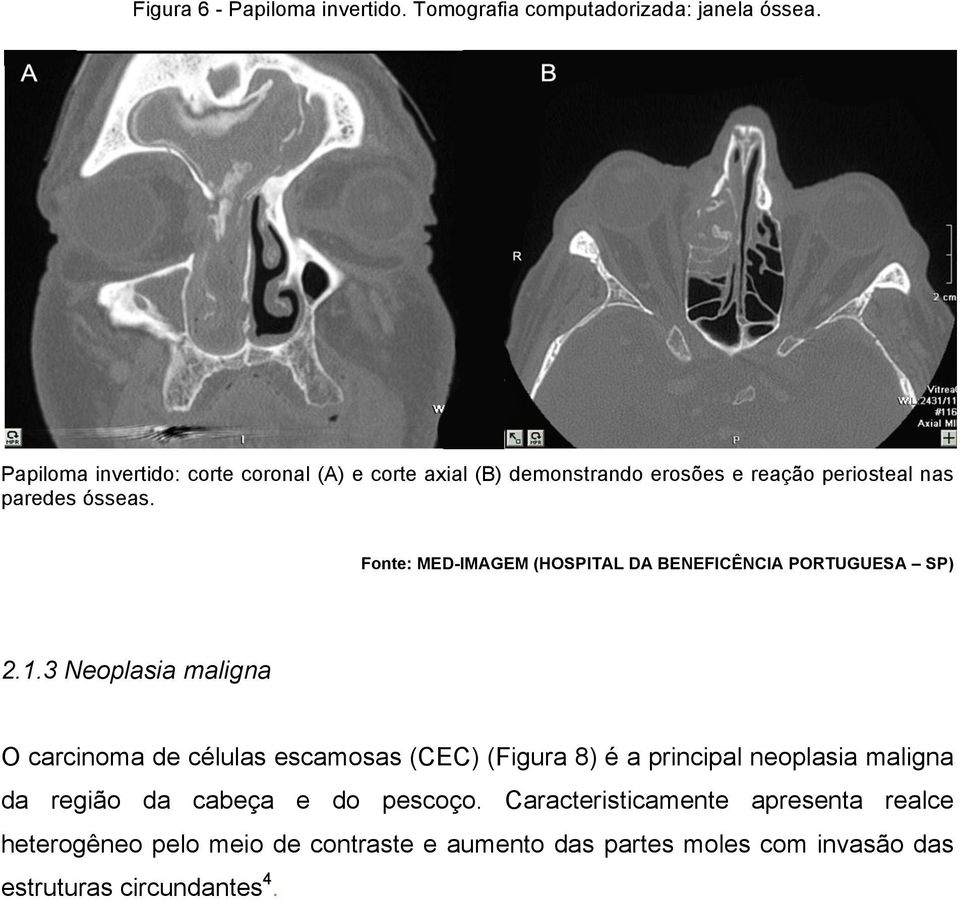 2.1.3 Neoplasia maligna O carcinoma de células escamosas (CEC) (Figura 8) é a principal neoplasia maligna da região