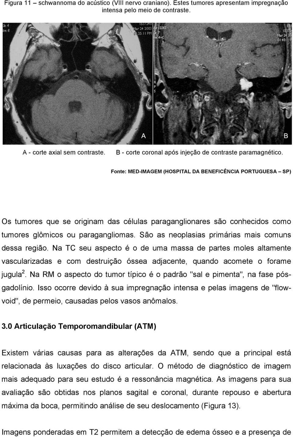 São as neoplasias primárias mais comuns dessa região. Na TC seu aspecto é o de uma massa de partes moles altamente vascularizadas e com destruição óssea adjacente, quando acomete o forame jugula 2.