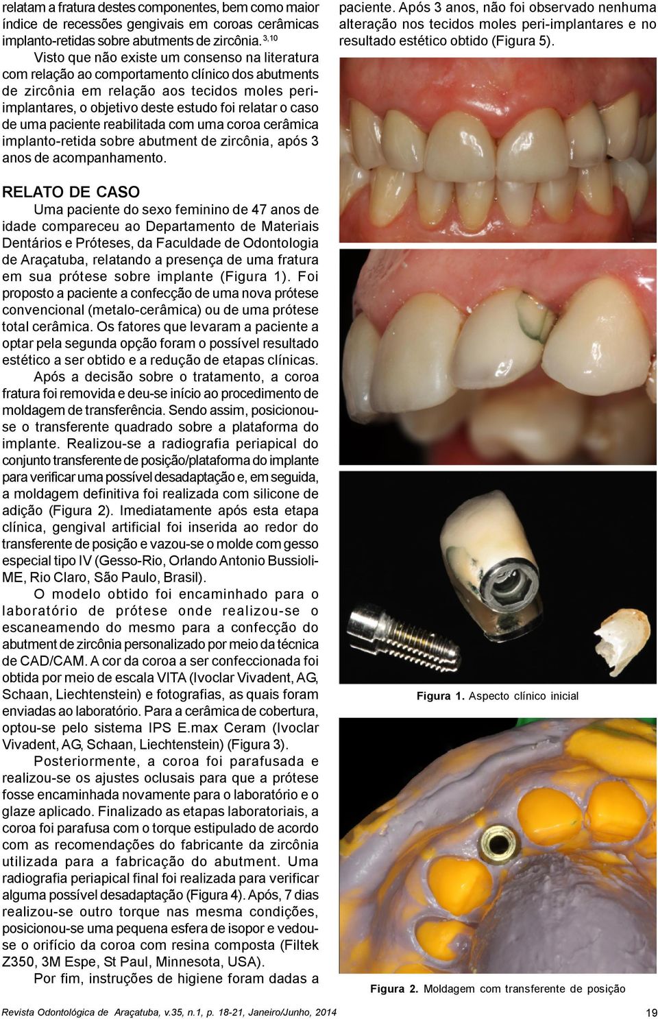 caso de uma paciente reabilitada com uma coroa cerâmica implanto-retida sobre abutment de zircônia, após 3 anos de acompanhamento. paciente. Após 3 anos, não foi observado nenhuma alteração nos tecidos moles peri-implantares e no resultado estético obtido (Figura 5).