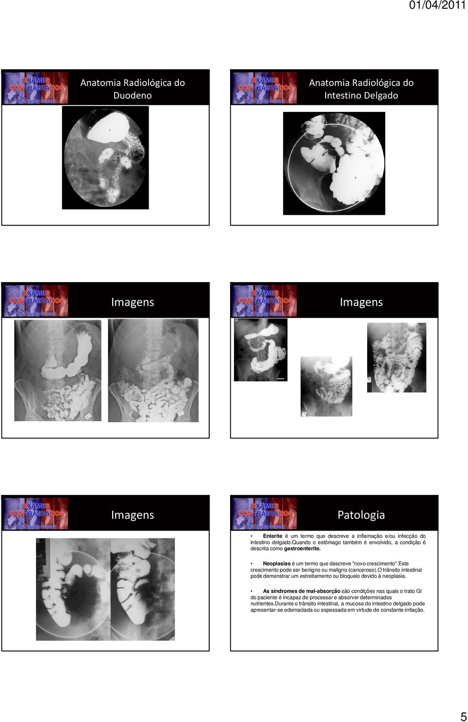 este crescimento pode ser benigno ou maligno (canceroso).o trânsito intestinal pode demonstrar um estreitamento ou bloqueio devido à neoplasia.