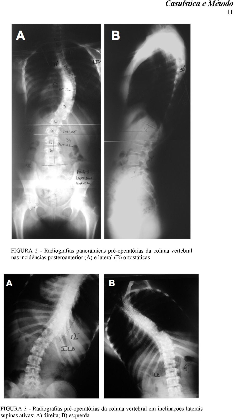 (A) e lateral (B) ortostáticas FIGURA 3 - Radiografias pré-operatórias