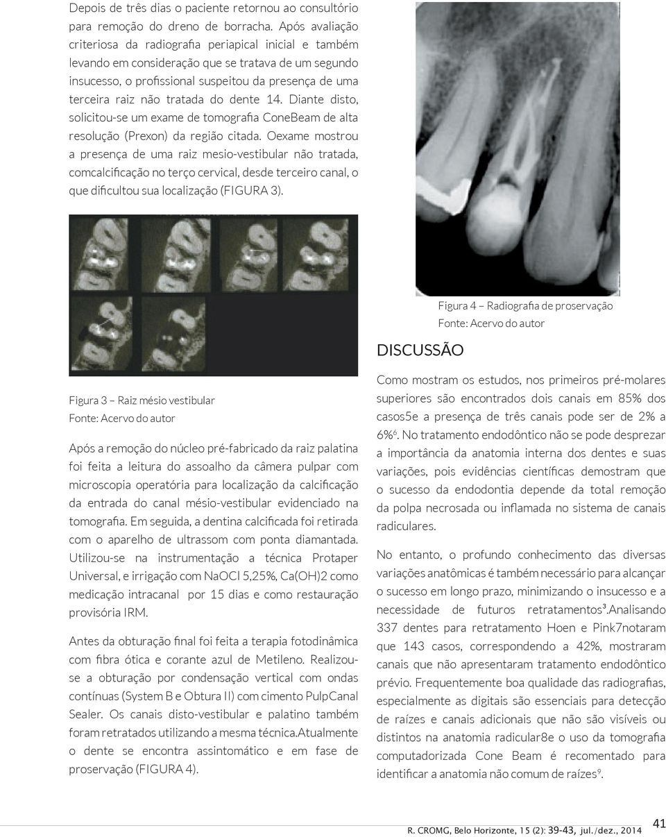 tratada do dente 14. Diante disto, solicitou-se um exame de tomografia ConeBeam de alta resolução (Prexon) da região citada.