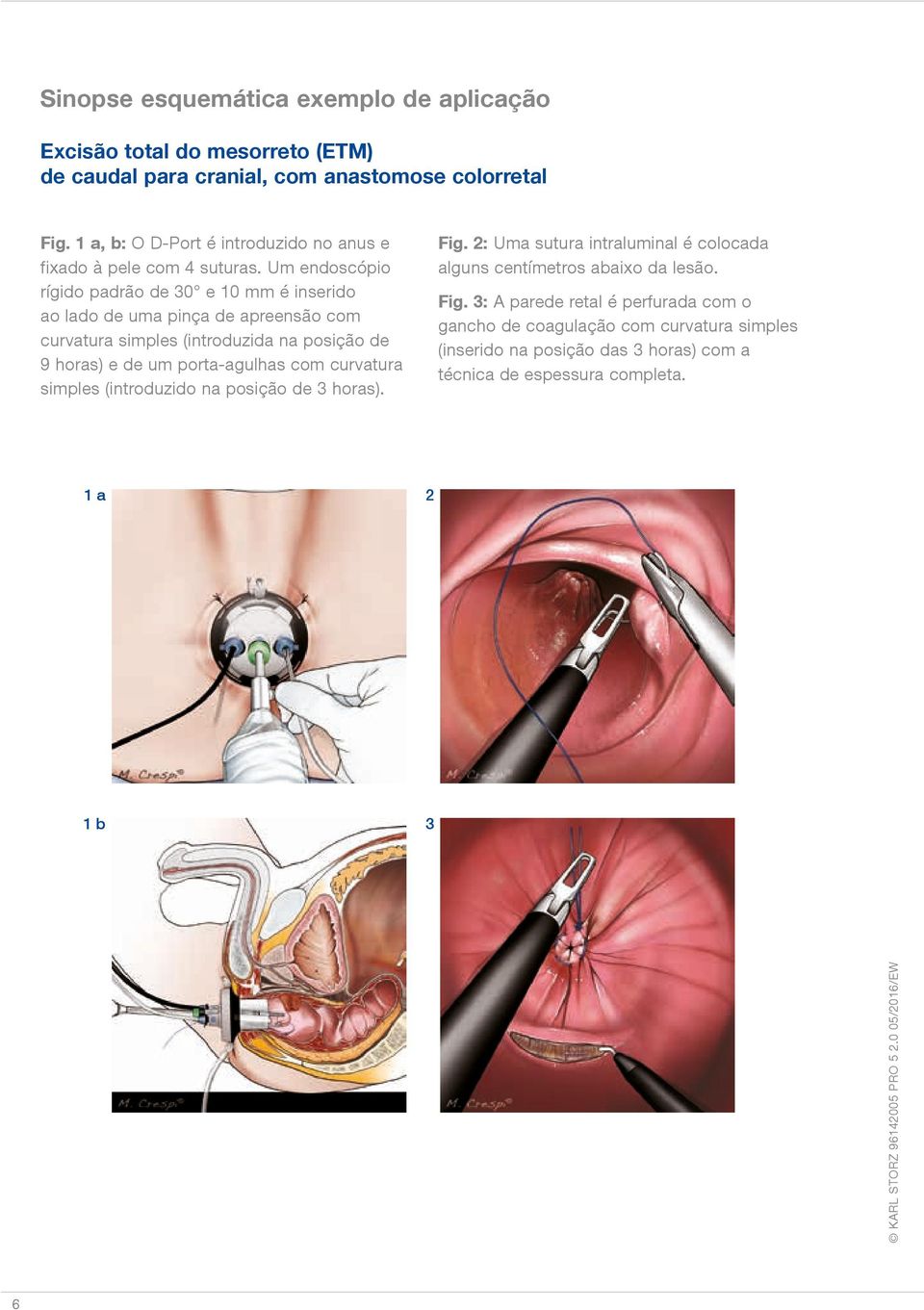 Um endoscópio rígido padrão de 30 e 10 mm é inserido ao lado de uma pinça de apreensão com curvatura simples (introduzida na posição de 9 horas) e de um porta-agulhas