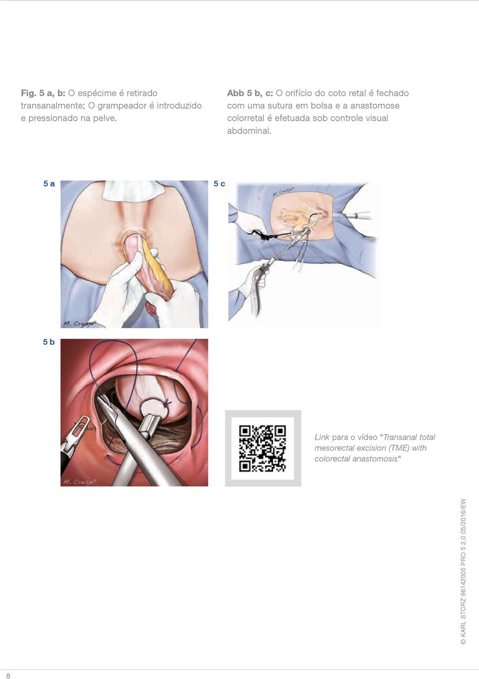 Abb 5 b, c: O orifício do coto retal é fechado com uma sutura em bolsa e a anastomose