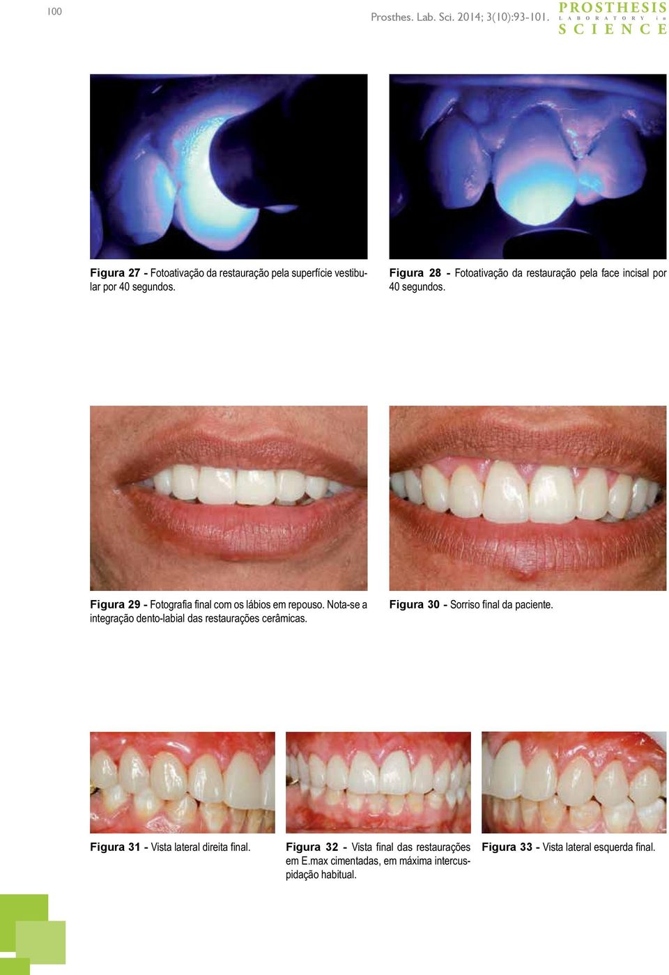 Figura 29 - Fotografia final com os lábios em repouso. Nota-se a integração dento-labial das restaurações cerâmicas.