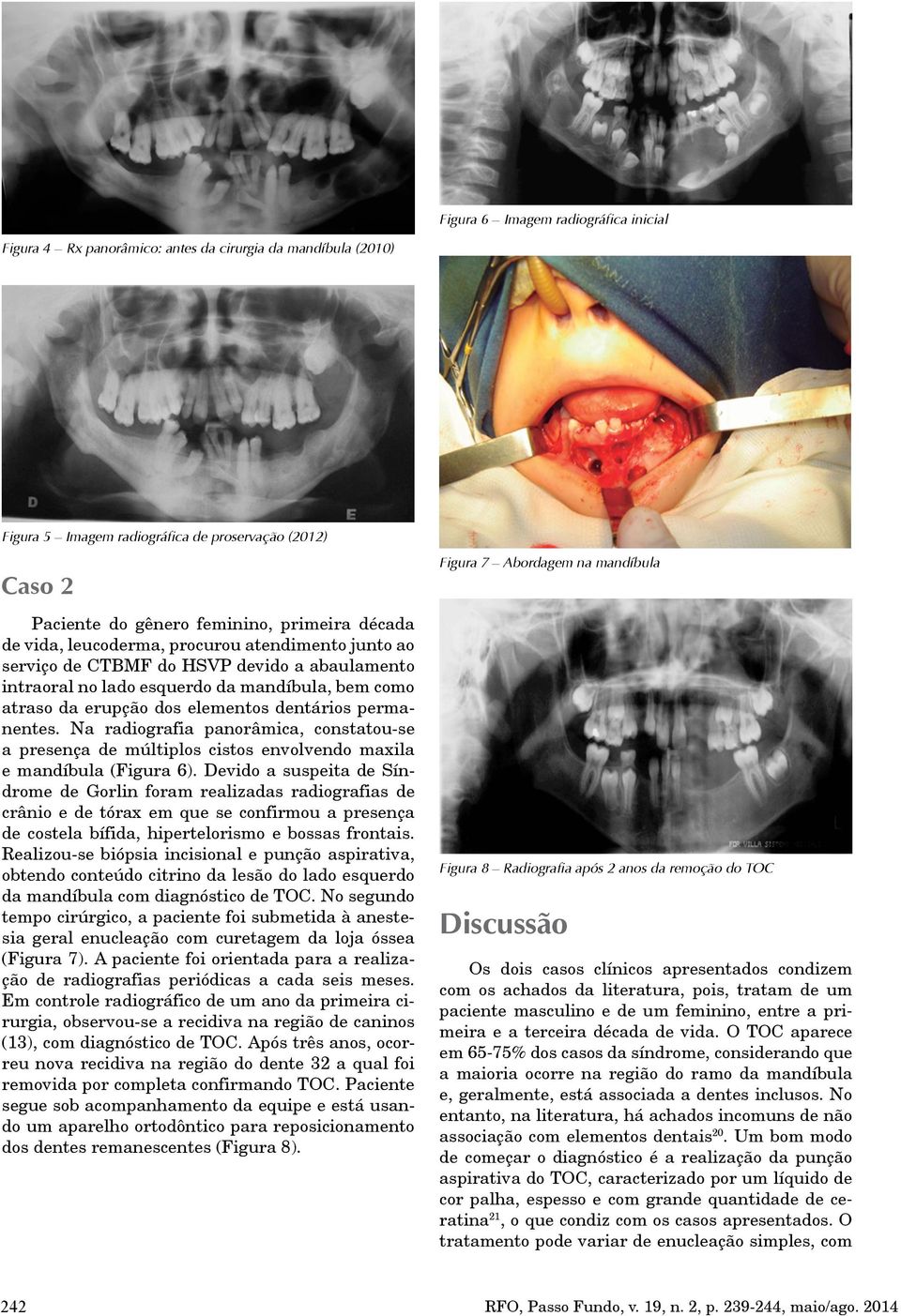 permanentes. Na radiografia panorâmica, constatou-se a presença de múltiplos cistos envolvendo maxila e mandíbula (Figura 6).