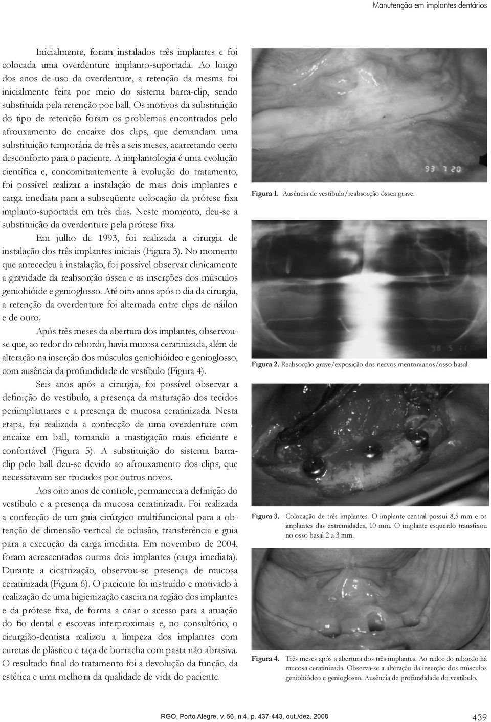 Os motivos da substituição do tipo de retenção foram os problemas encontrados pelo afrouxamento do encaixe dos clips, que demandam uma substituição temporária de três a seis meses, acarretando certo